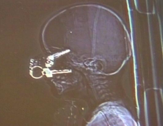 http://reho.st/a.abcnews.com/images/Health/abc_keys_eye_02_081126_ssh.jpg