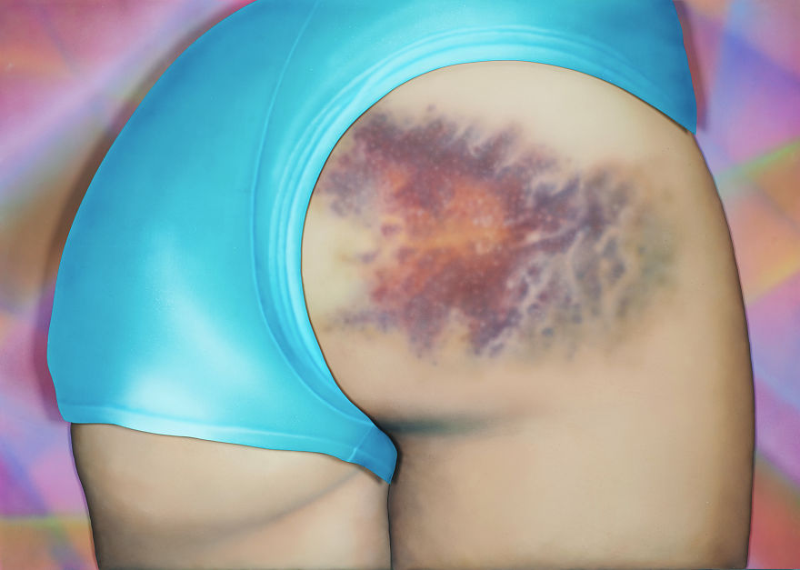 http://reho.st/static.boredpanda.com/blog/wp-content/uploads/2015/09/I-Got-a-Really-Beautiful-Bruise-small1__880.jpg
