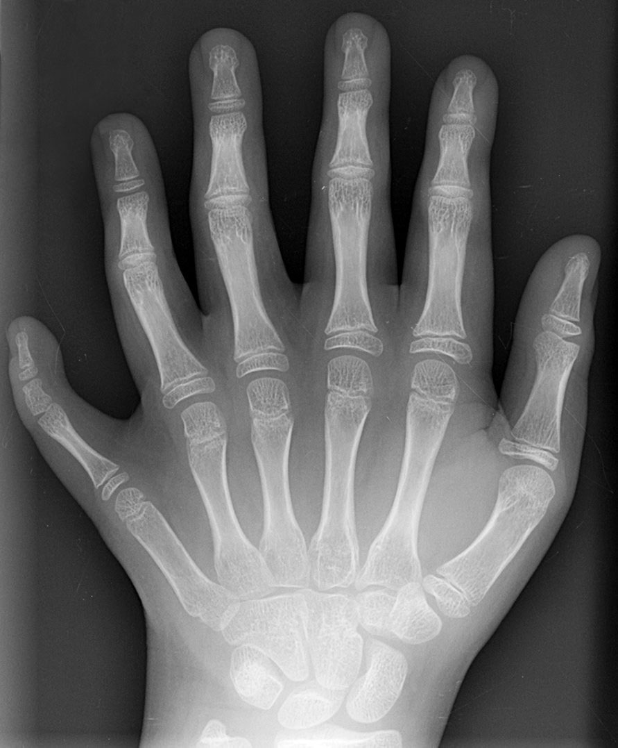 https://reho.st/https://upload.wikimedia.org/wikipedia/commons/1/1c/Polydactyly_01_Lhand_AP.jpg https://reho.st/https://upload.wikimedia.org/wikipedia/commons/1/1c/Polydactyly_01_Lhand_AP.jpg
